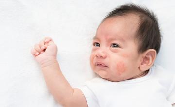 EXPERTS ADVICE HOW TO TAKE CARE OF A CHILD WITH ECZEMA